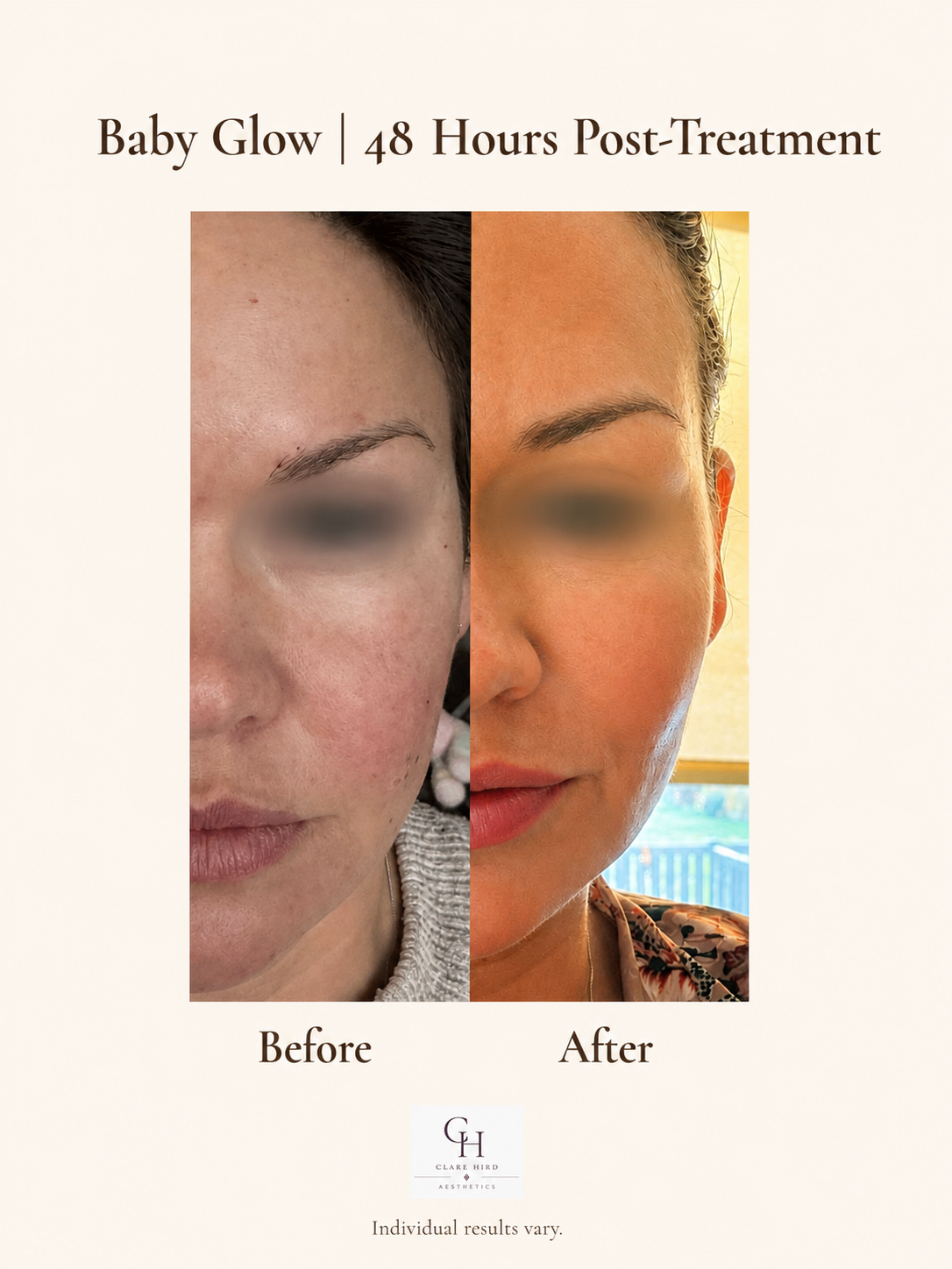 Baby Glow skin booster before and after 48 hours
