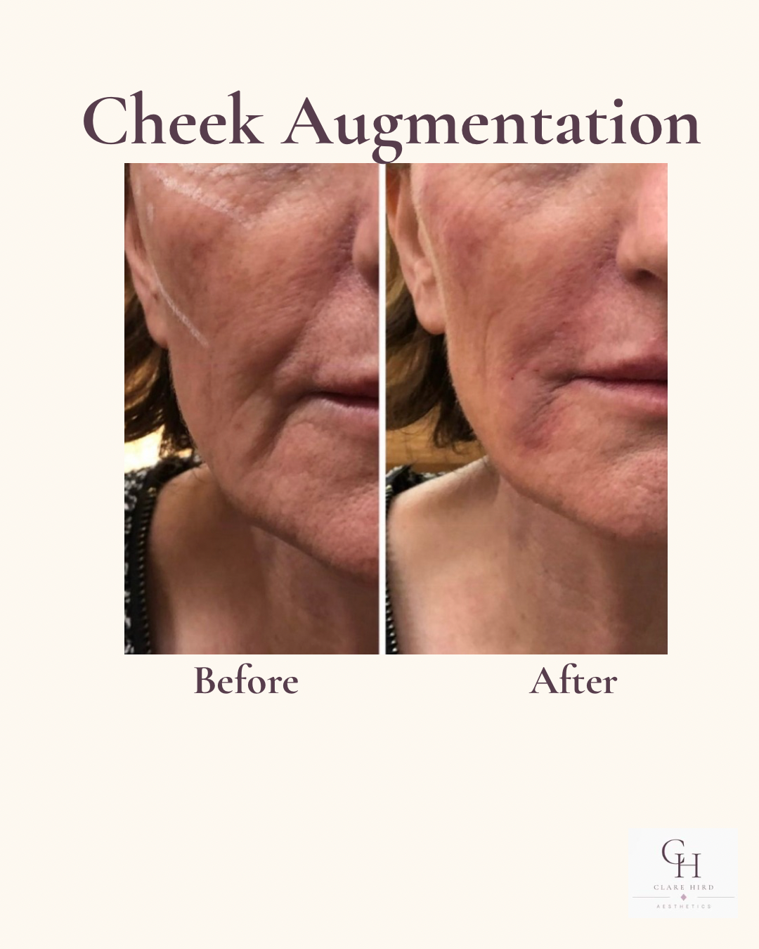 Cheek volume restoration before and after