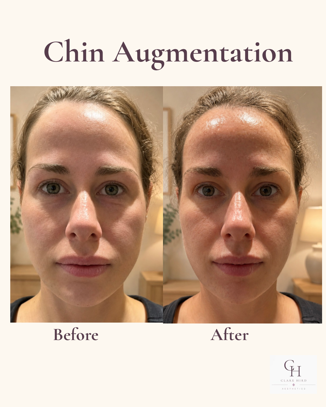 Chin definition before and after