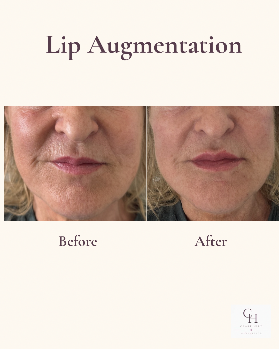 Natural lip enhancement before and after frontal view