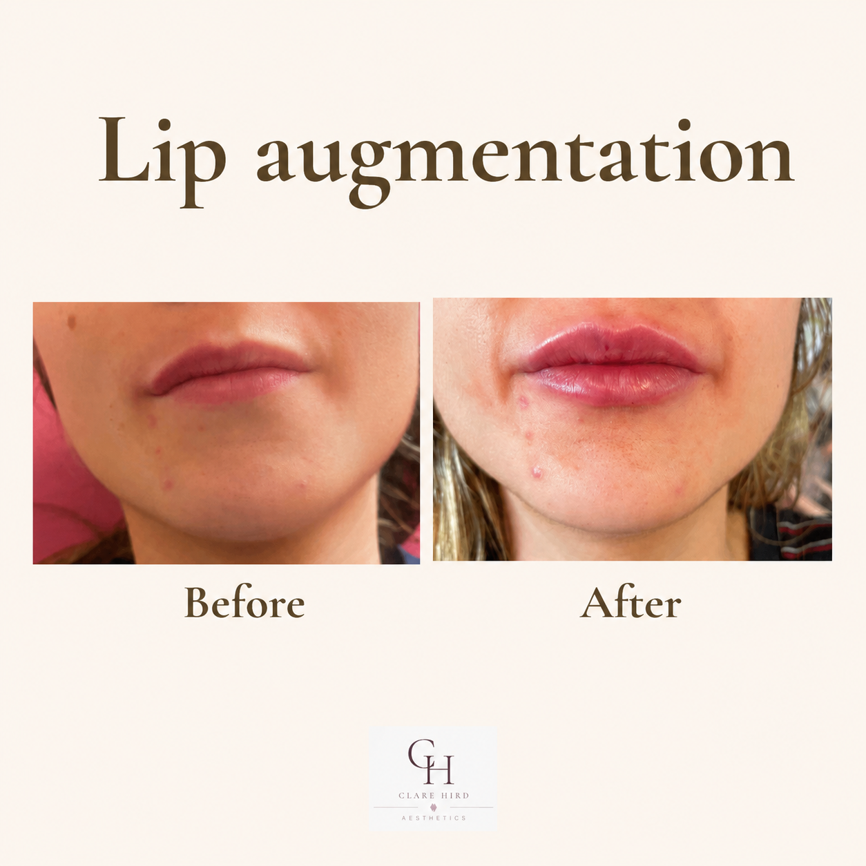 Natural lip enhancement before and after