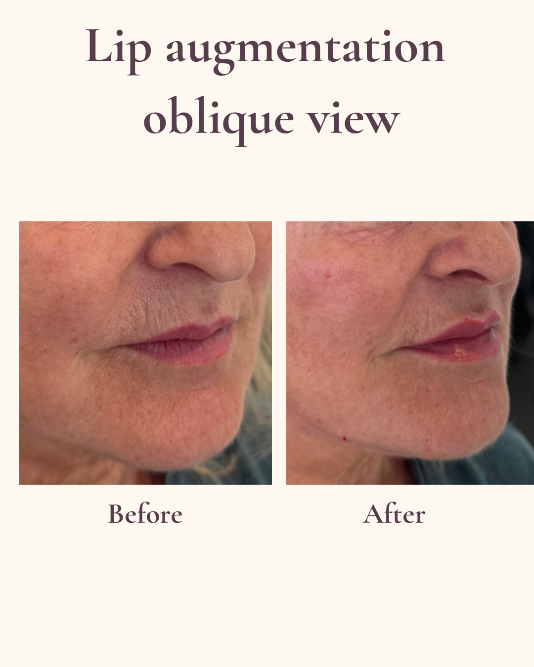 Natural lip enhancement before and after oblique view