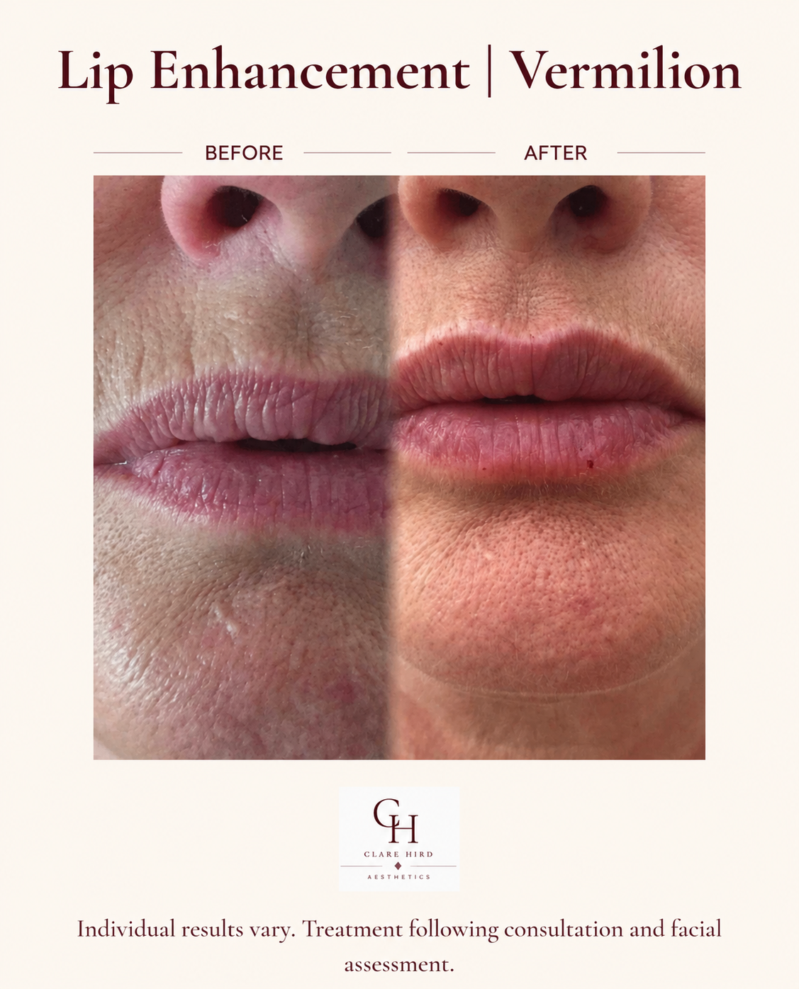 Lip enhancement vermilion border before and after