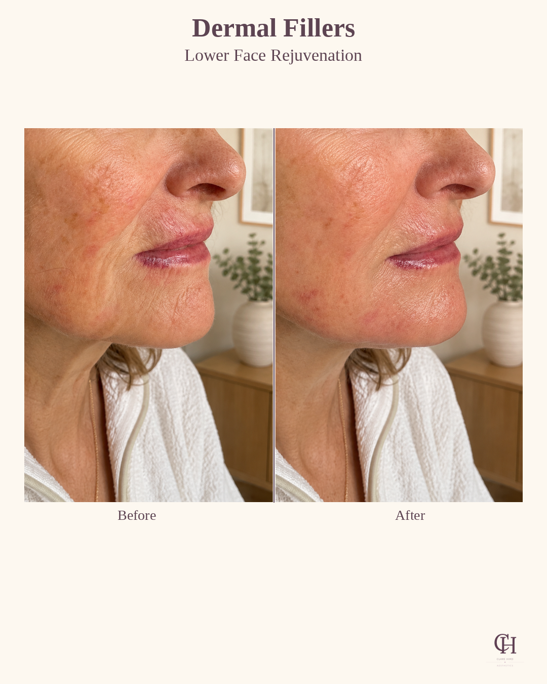 Lower face dermal filler before and after close up