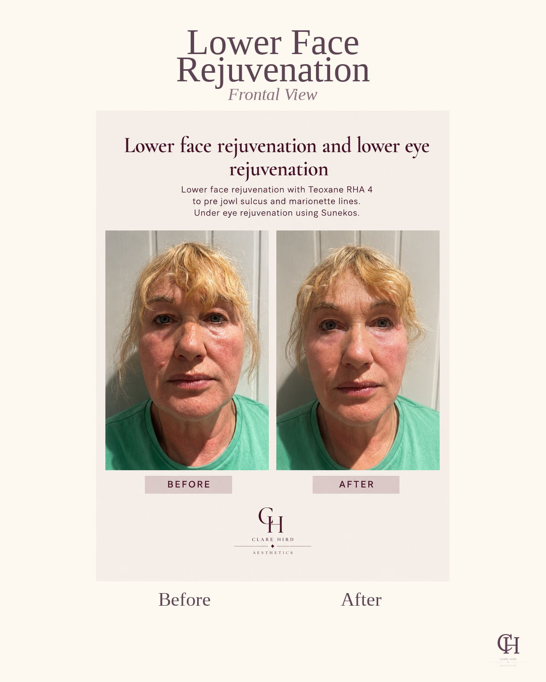 Lower face rejuvenation frontal view