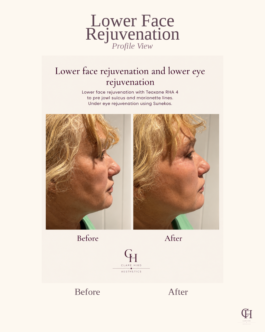 Lower face rejuvenation lateral view