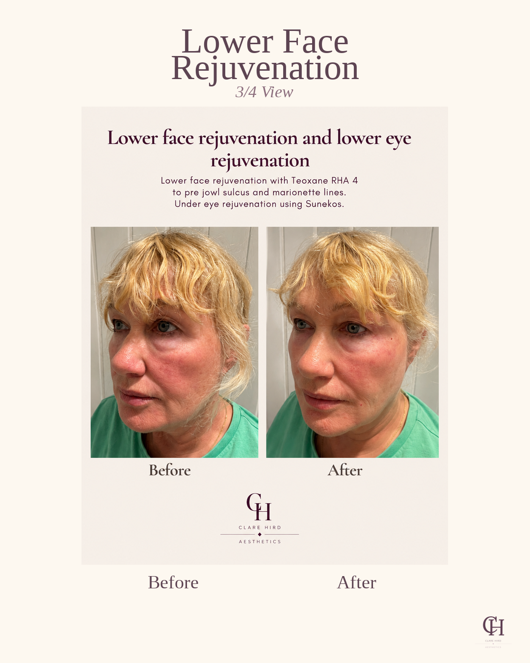 Lower face rejuvenation oblique view