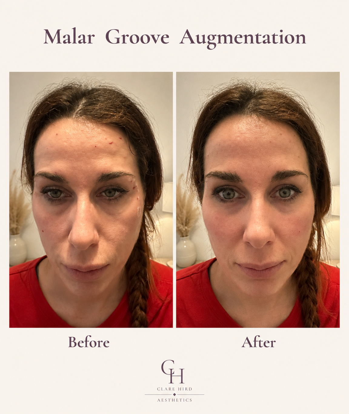 Malar groove treatment before and after