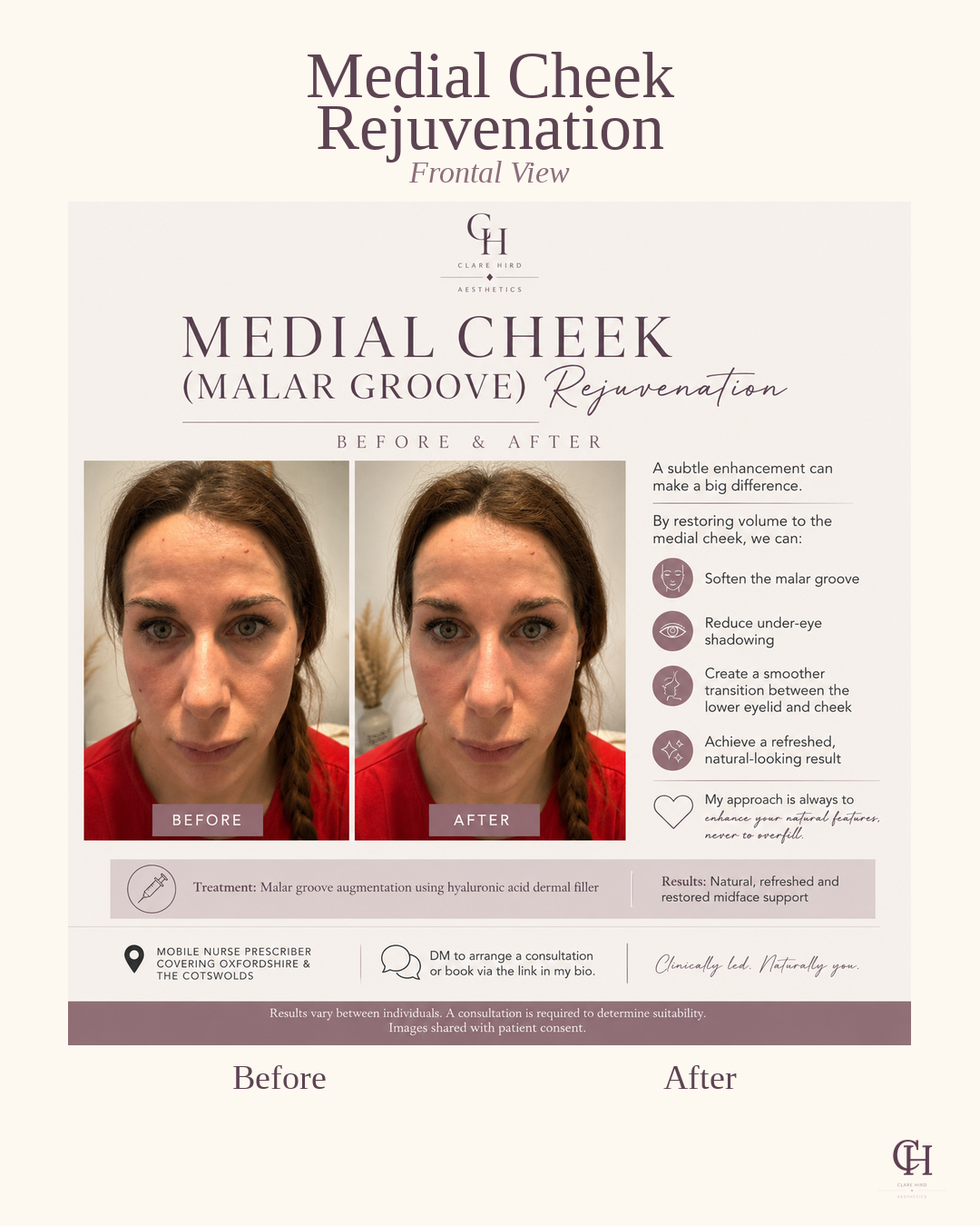 Medial cheek augmentation frontal view before and after