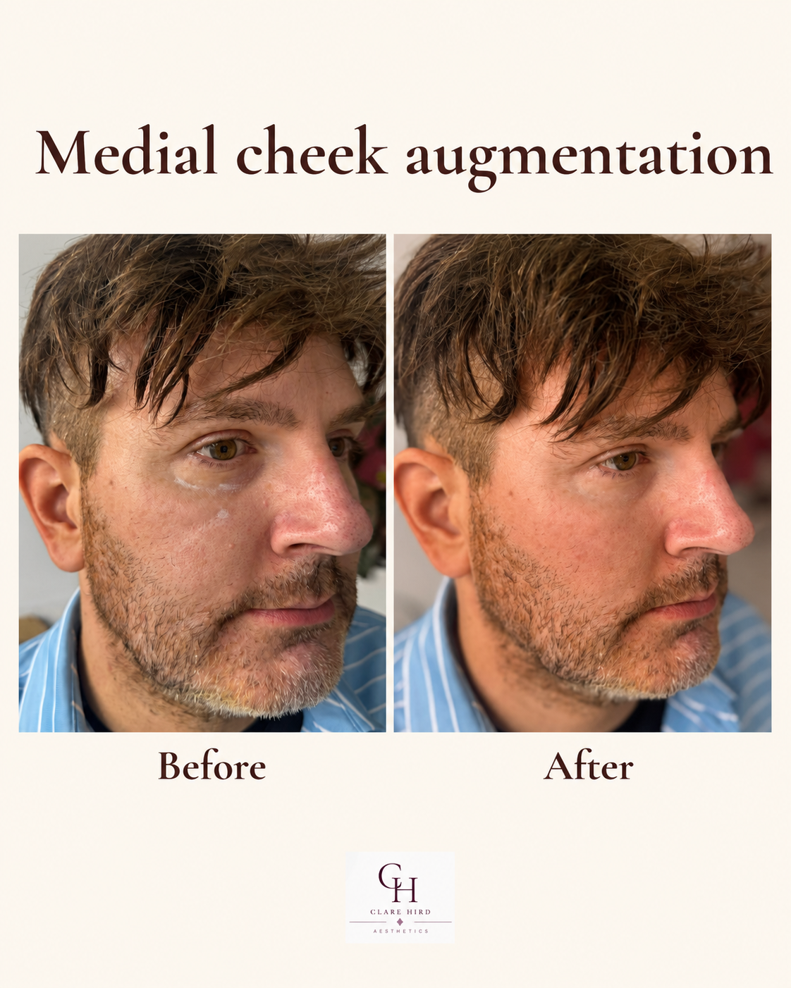 Medial cheek augmentation before and after