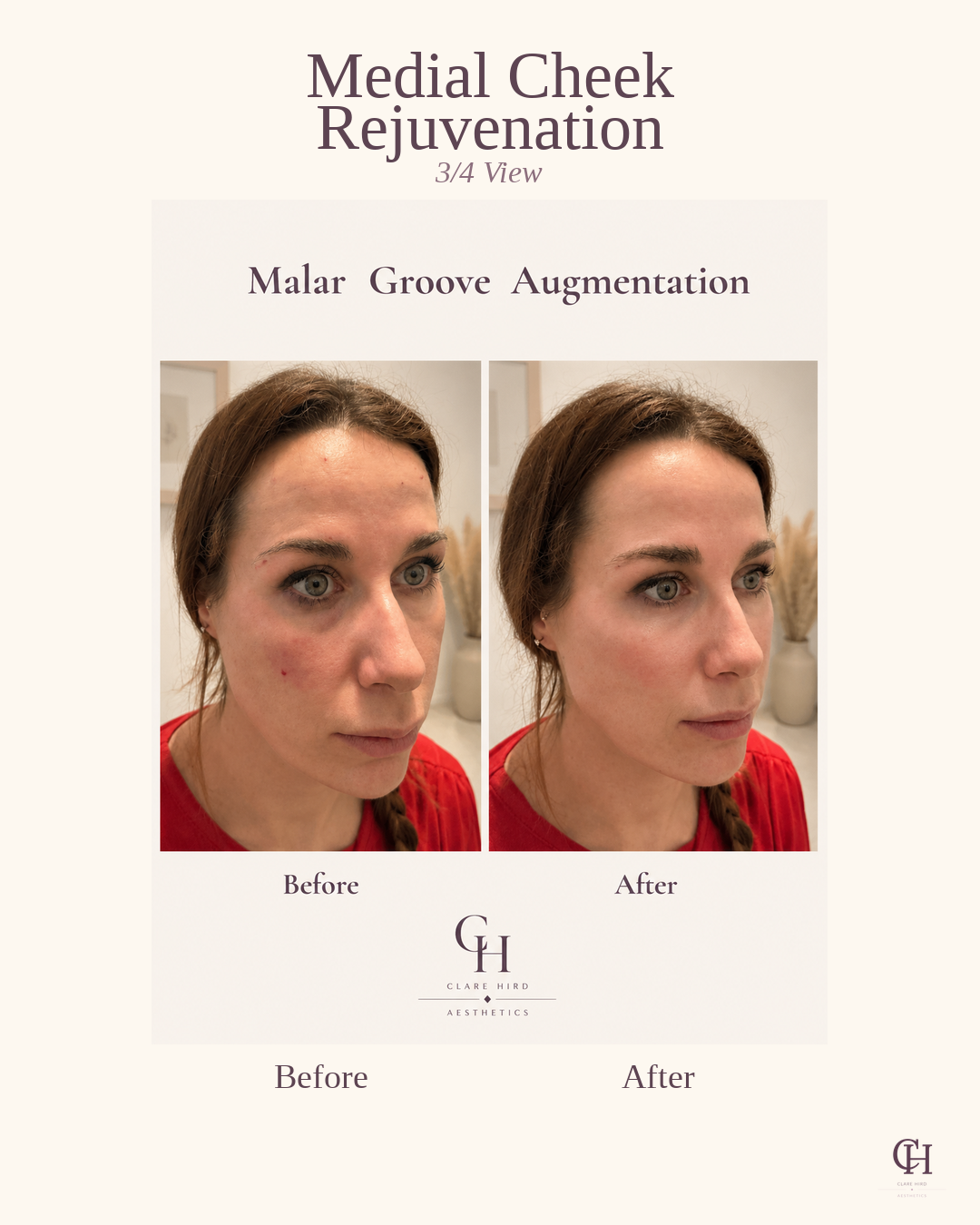 Medial cheek augmentation oblique view before and after