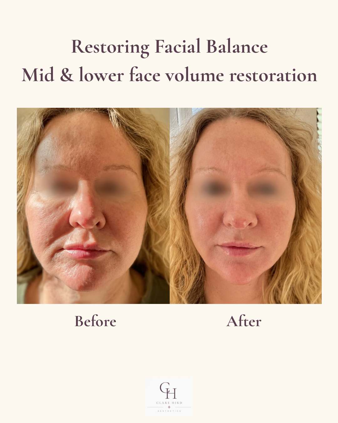 Mid and lower face volume restoration before and after frontal view