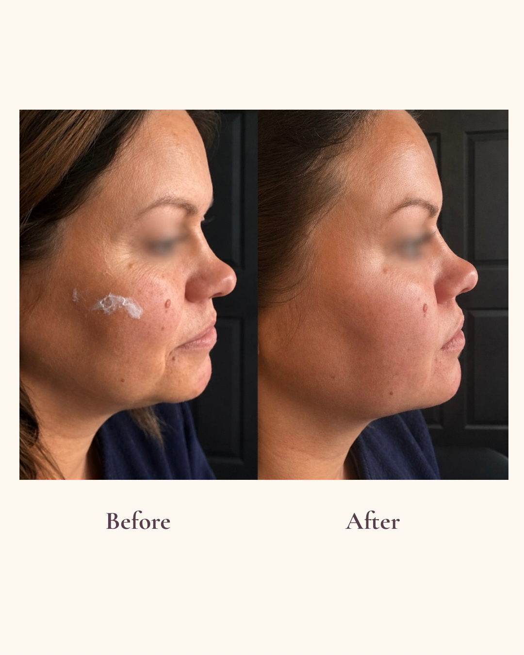 Mid and lower face volume restoration frontal view before and after