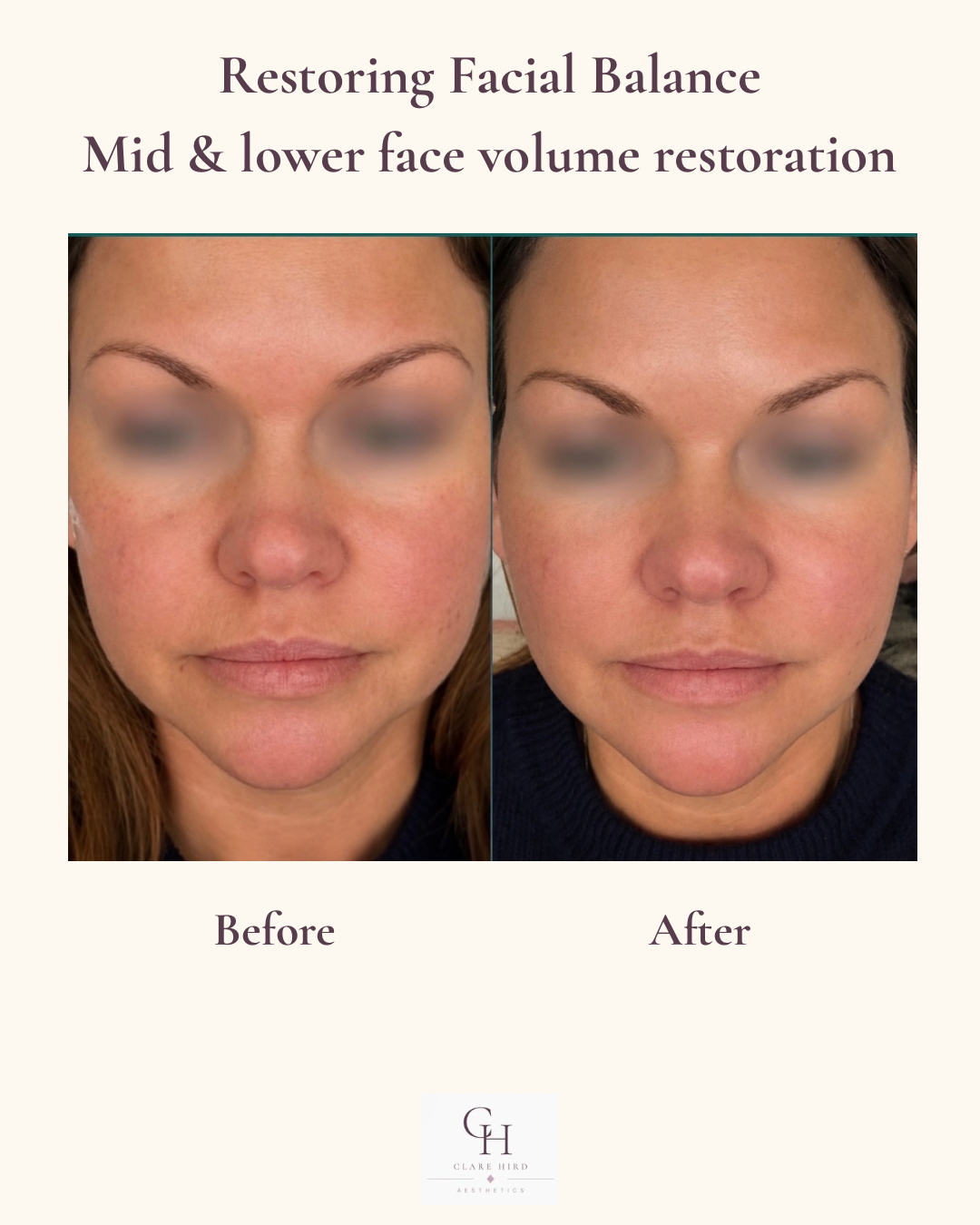 Mid and lower face volume restoration profile view before and after