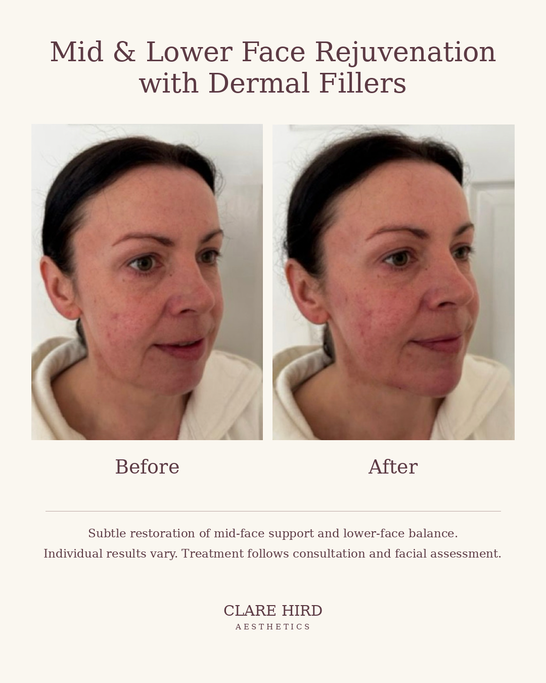 Mid and lower face rejuvenation with dermal fillers before and after