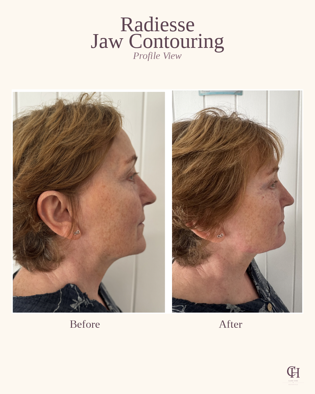 Jawline definition profile view before and after