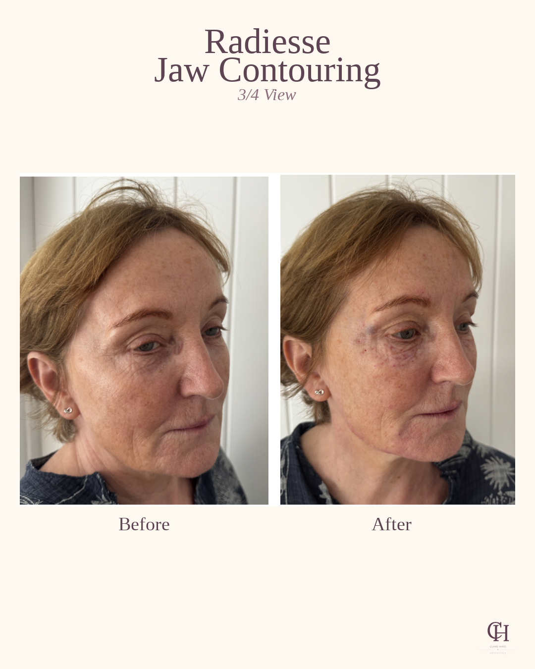 Jawline definition oblique view before and after