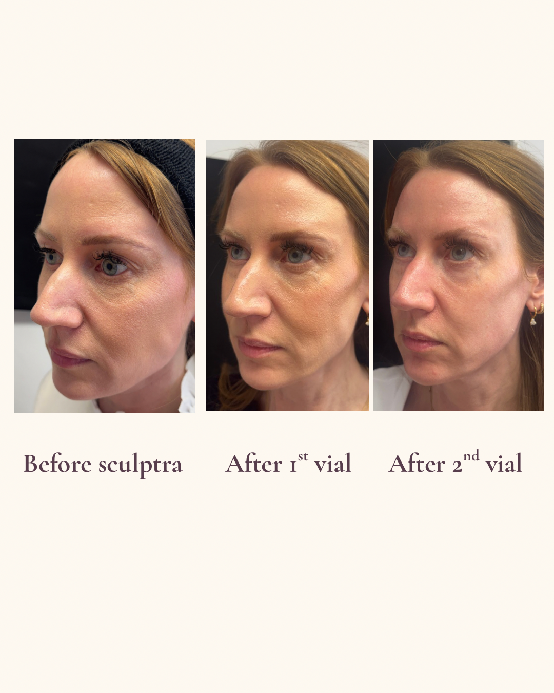 Sculptra collagen stimulation 3/4 view before and after
