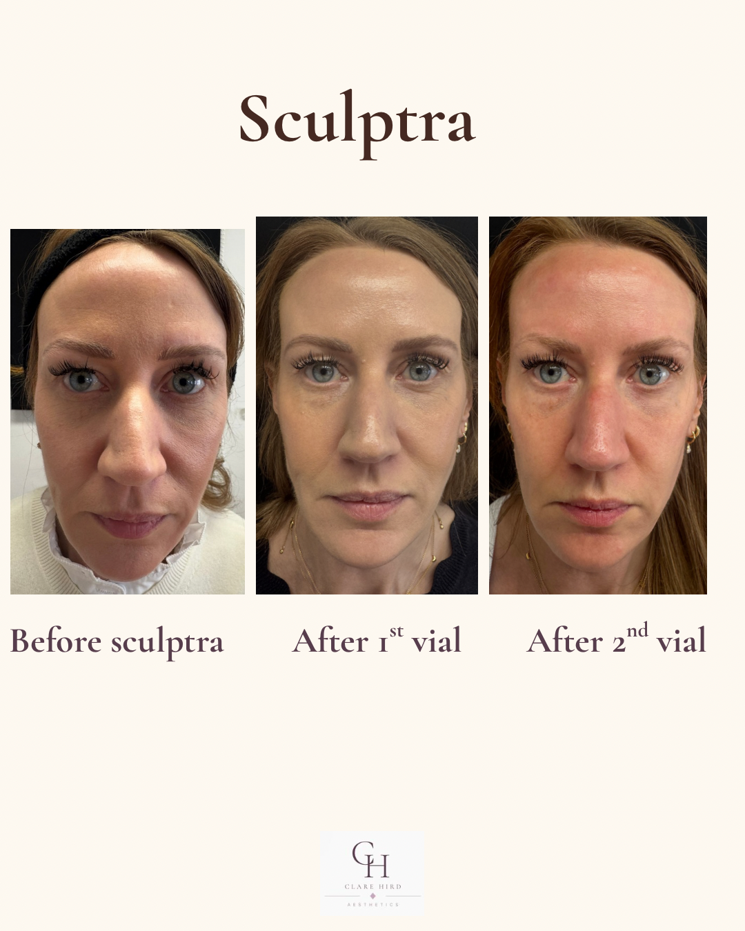 Sculptra collagen stimulation before and after frontal view