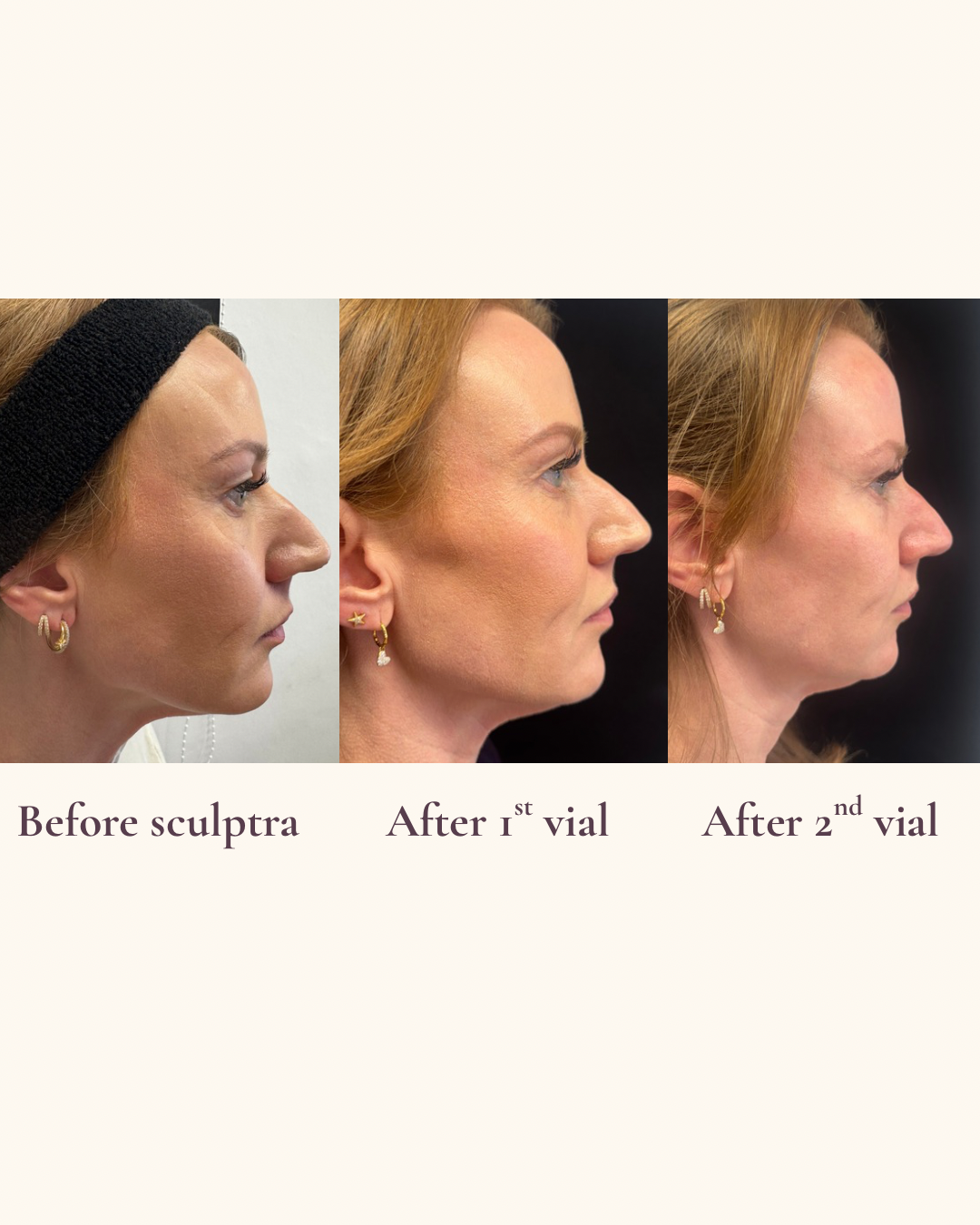 Sculptra collagen stimulation profile view before and after