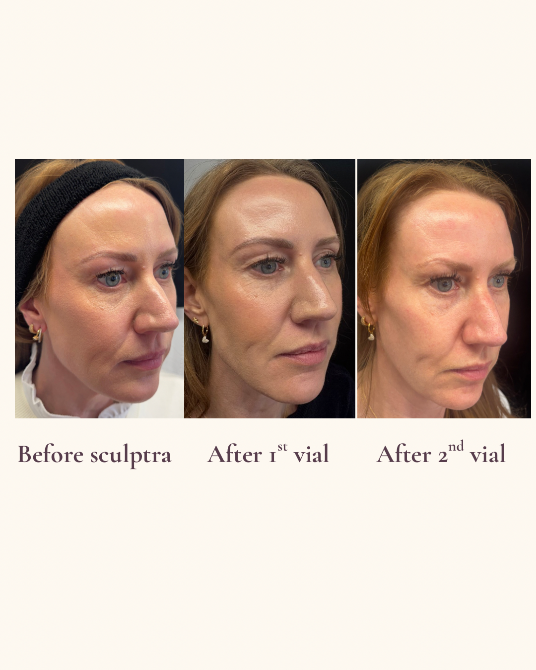 Sculptra collagen stimulation oblique view before and after