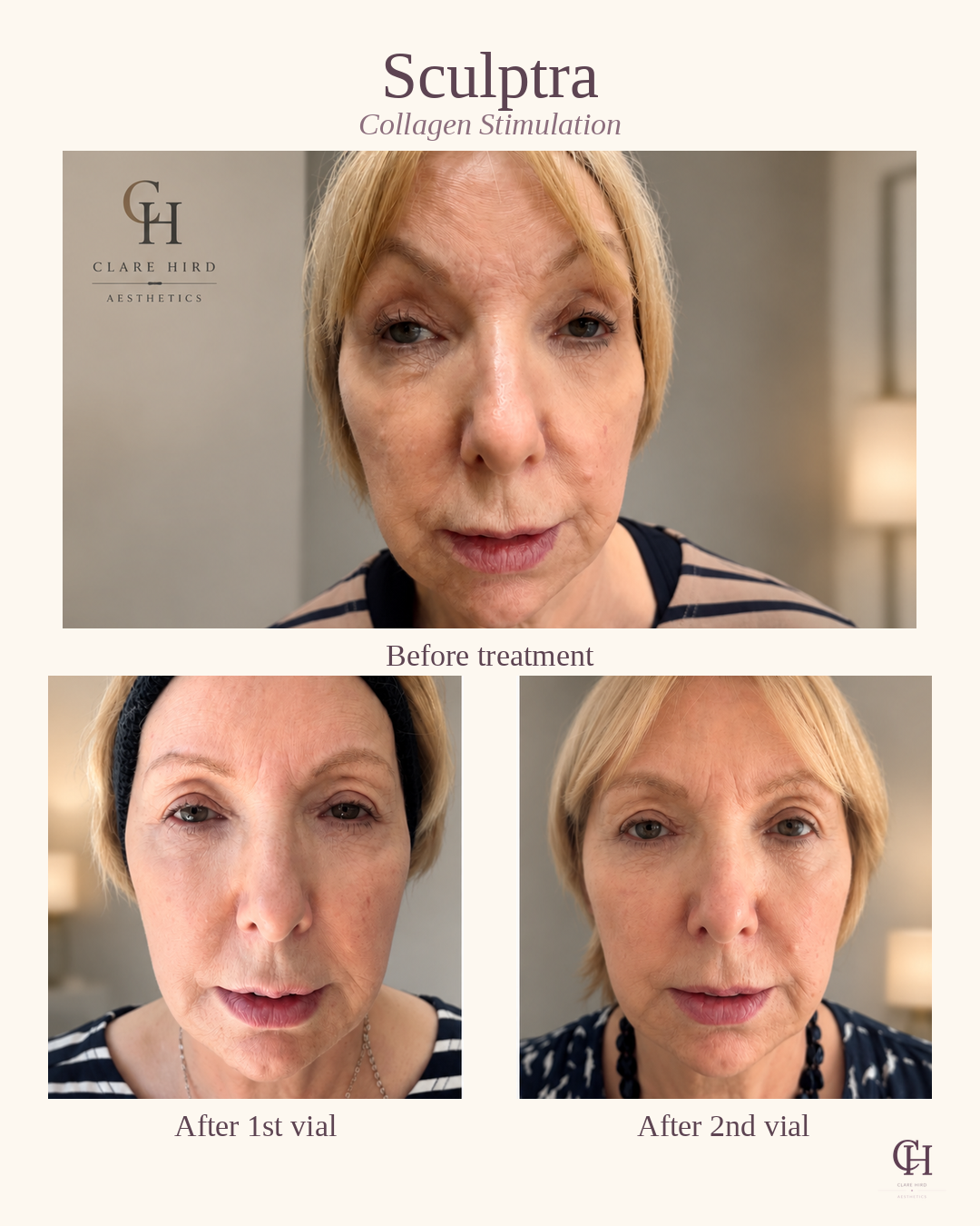 Sculptra before and after 1st and 2nd vial