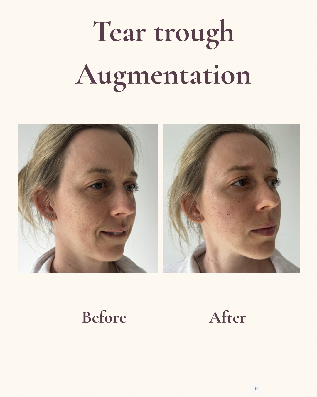 Under-eye rejuvenation before and after