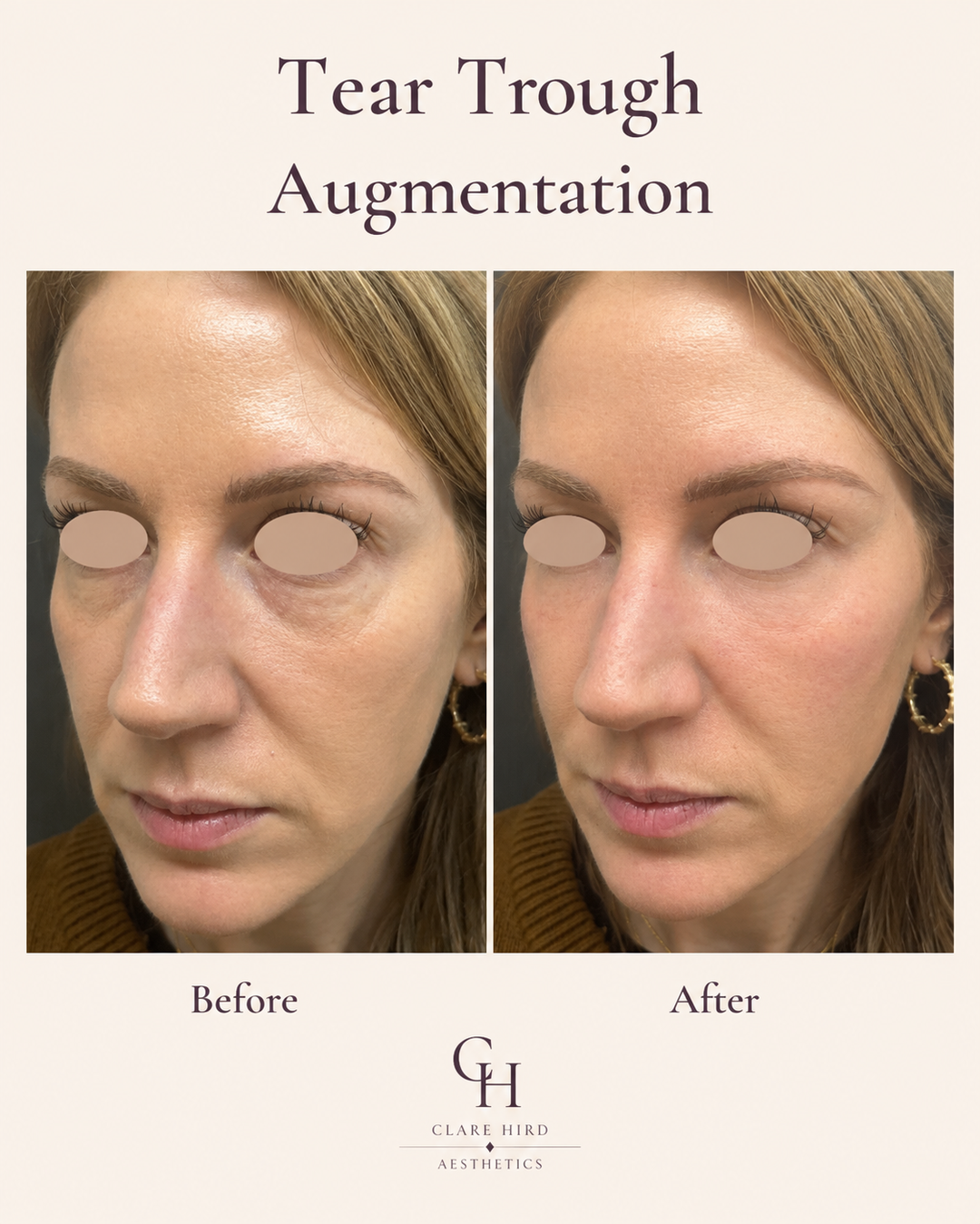 Under-eye rejuvenation oblique view before and after