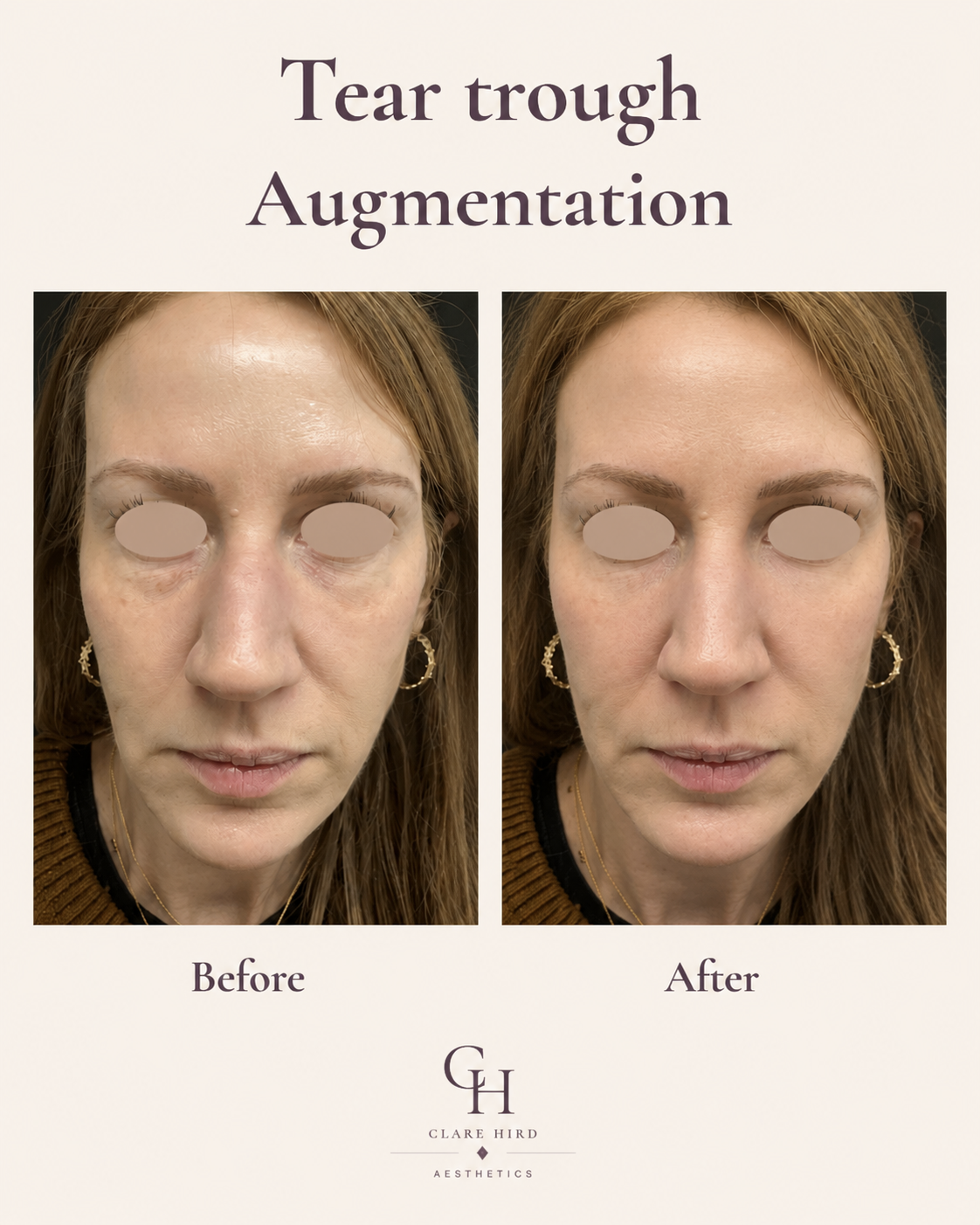 Under-eye rejuvenation frontal view before and after