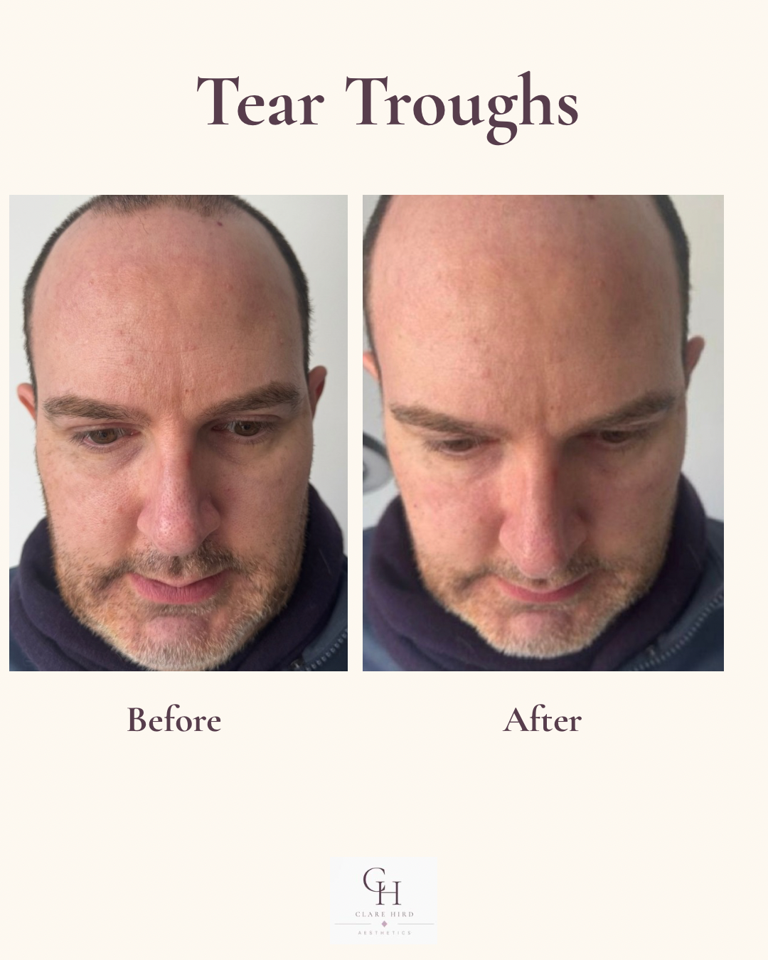 Male tear trough treatment before and after