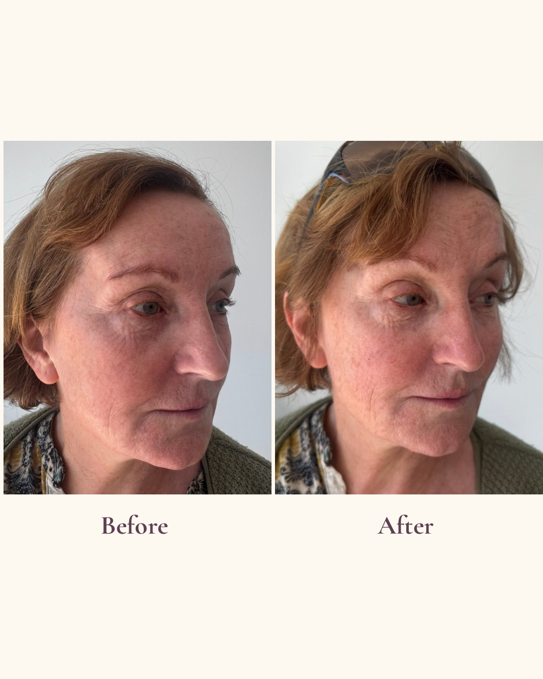 Strategic volume restoration three quarter view before and after