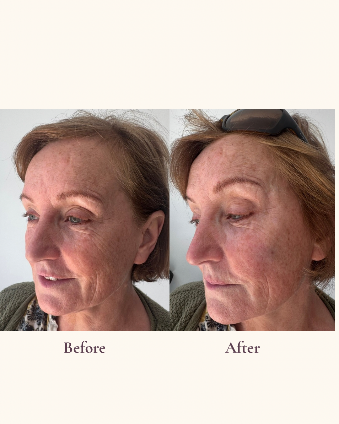 Strategic volume restoration temples cheek tear troughs before and after