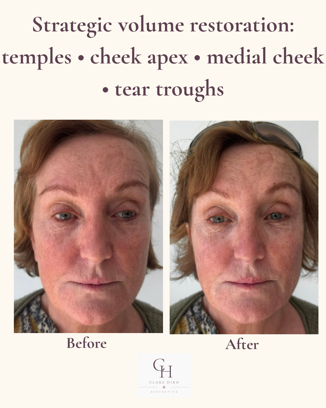 Strategic volume restoration oblique view before and after